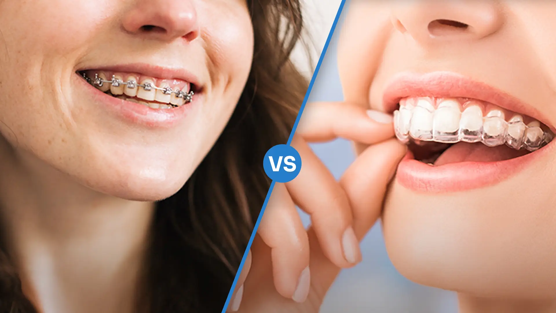 Invisalign vs traditional braces: which is right for you?